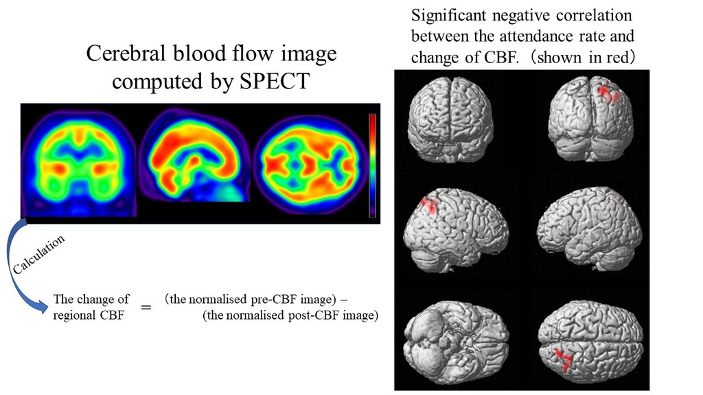 軽度認知機能障害を対象とした多要素デイケアが局所脳血流にもたらす影響についてpage-visual 軽度認知機能障害を対象とした多要素デイケアが局所脳血流にもたらす影響についてビジュアル